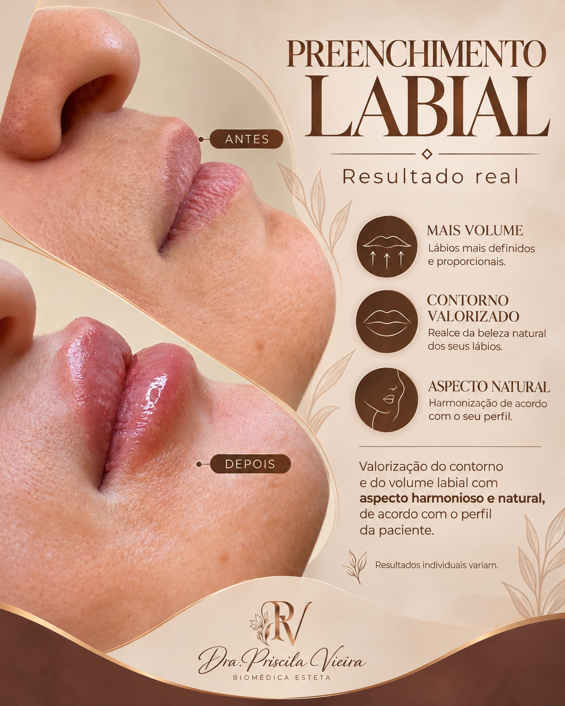Cartão de resultado real de preenchimento labial com antes e depois